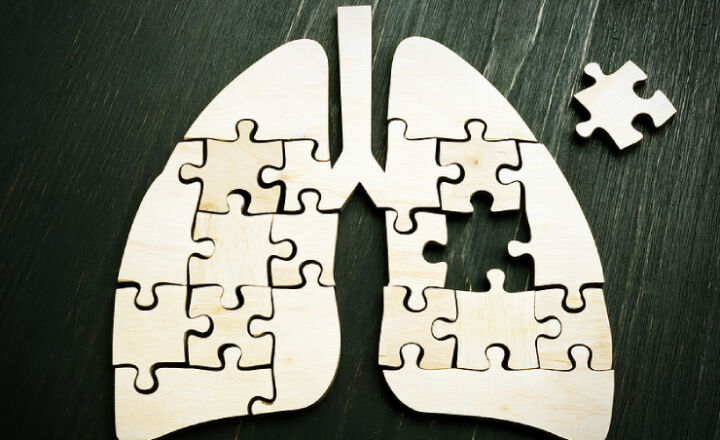7 Frequently Asked Questions About Lung Cancer And Treatment