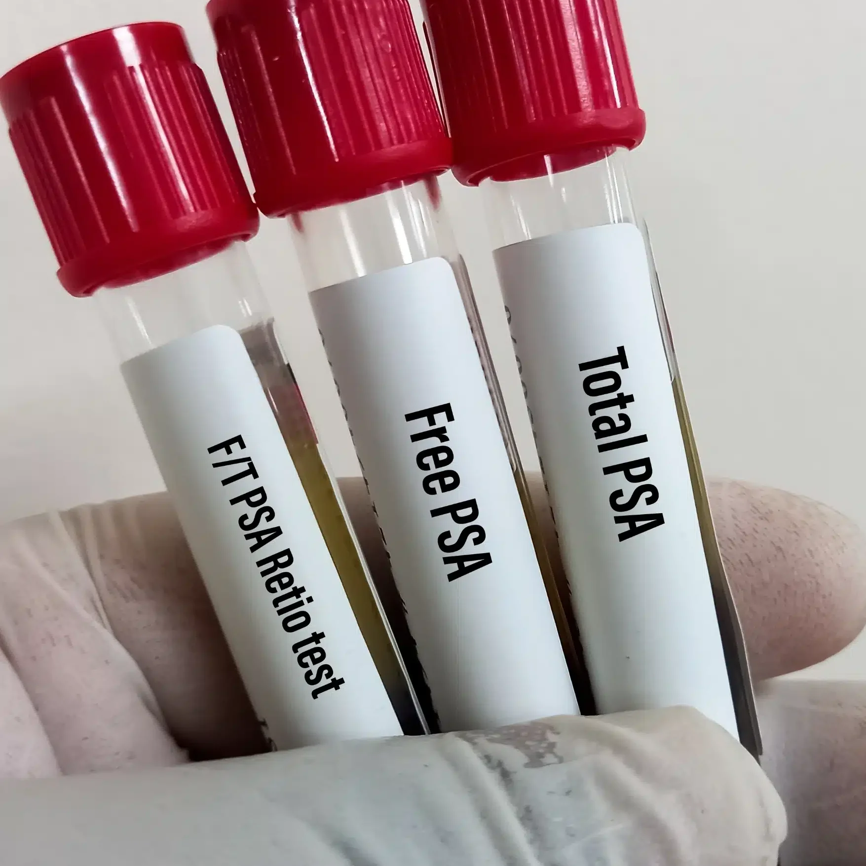 Prostate Cancer | International Cancer Specialists, Singapore